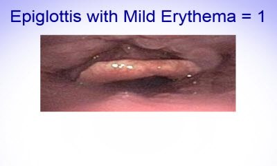 Scoring Epiglottis 6