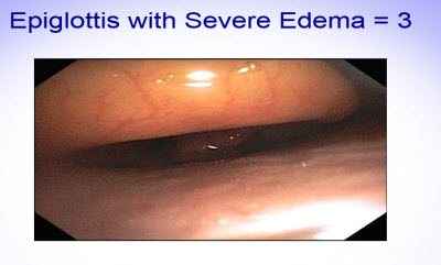 Scoring Epiglottis 4