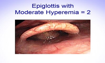 Scoring Epiglottis 7
