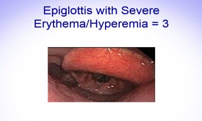 Scoring Epiglottis 8
