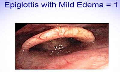 Scoring Epiglottis 2