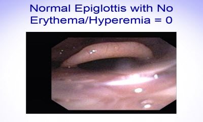Scoring Epiglottis 5