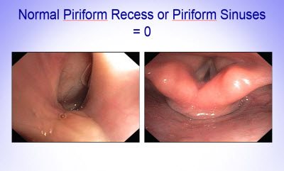 Piriform Recess 1