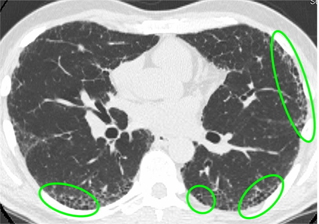 Uip Pattern Pulmonary Fibrosis | community participation program for pulmonary fibrosis Uip Pattern Pulmonary Fibrosis | community participation program for pulmonary fibrosis