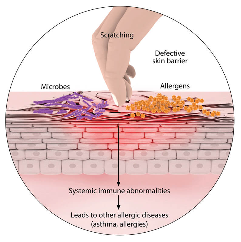 Pathophysiology Of Atopic Dermatitis