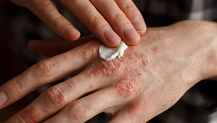 Taking Care of Dry Skin Caused by Frequent Hand Washing