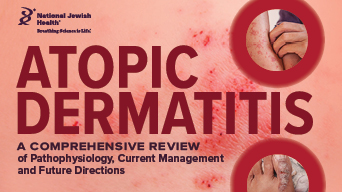 Atopic Dermatitis: A Comprehensive Review of Pathophysiology, Current Management, and Future Directions